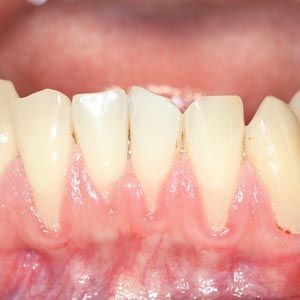 Receding Gums
